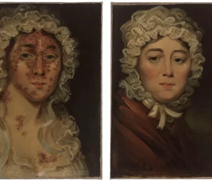 Sra. Bennet e seu impetigo