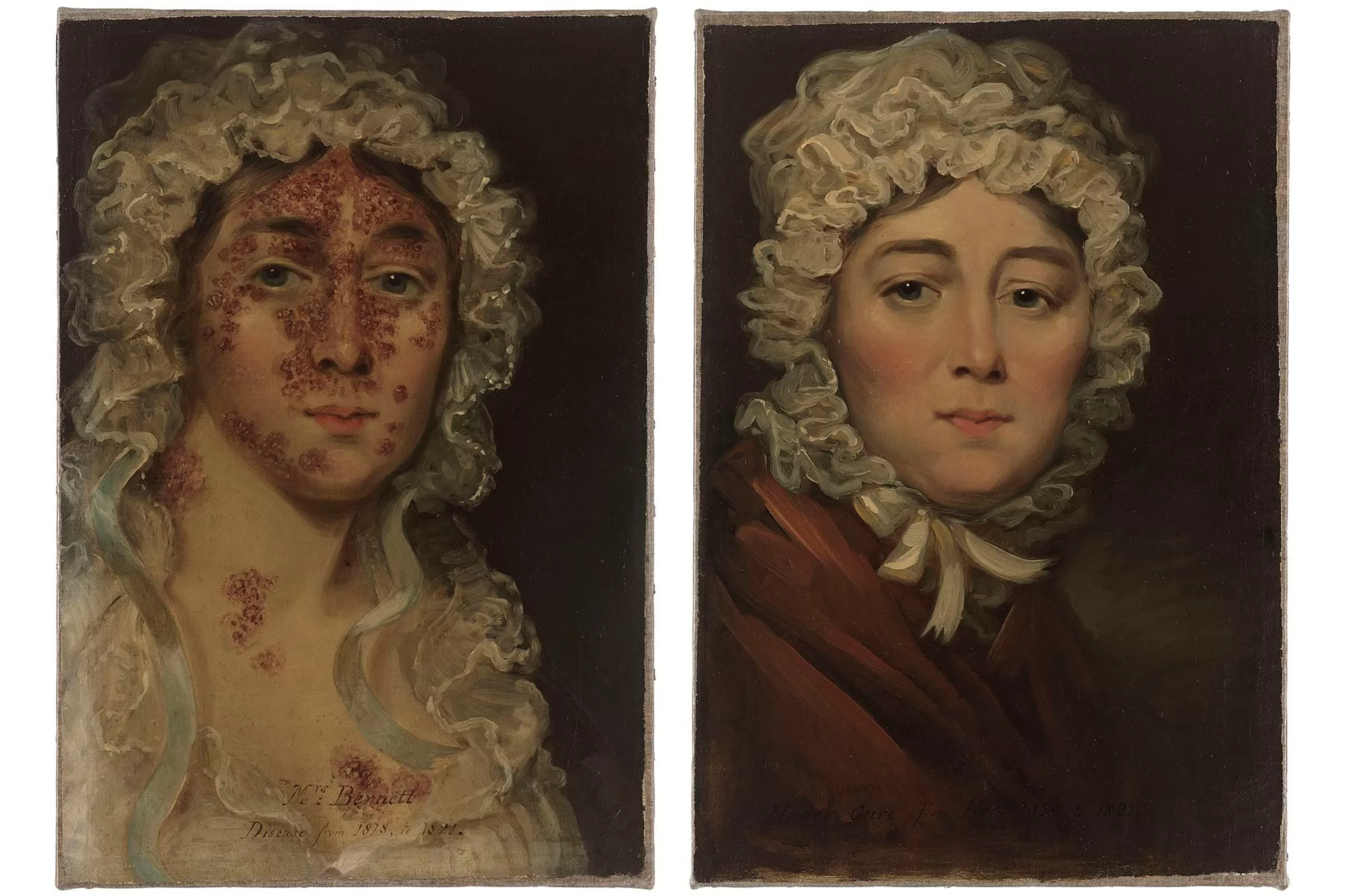 Sra. Bennet e seu impetigo