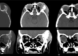 NEUROBLASTOMA
