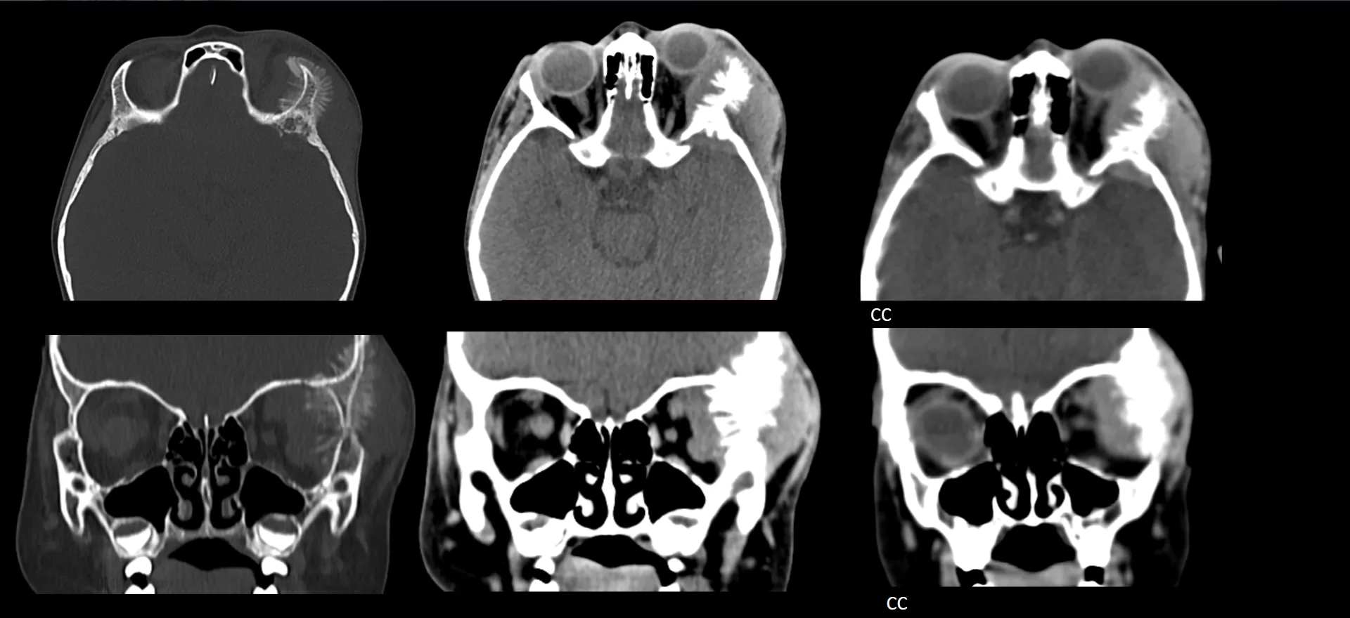 NEUROBLASTOMA