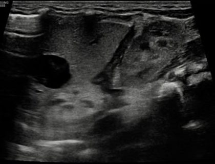1. Imagem sólido-cística, predominantemente ecogênica, com fluxo ao estudo Doppler, localizada no retroperitônio, deslocando a adrenal esquerda inferiormente (paciente com dois dias de vida)