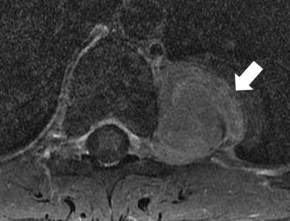 4. RM de coluna torácica axial T1 fat sat pós-contraste: lesão paravertebral esquerda com realce pelo meio de contraste (seta branca)