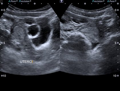 1. Ultrassonografia demonstra imagem que sugere hidrossalpinge medializada em relação ao útero, e liquido livre laminar na pelve, associado a intensa densificação de planos adiposos adjacentes
