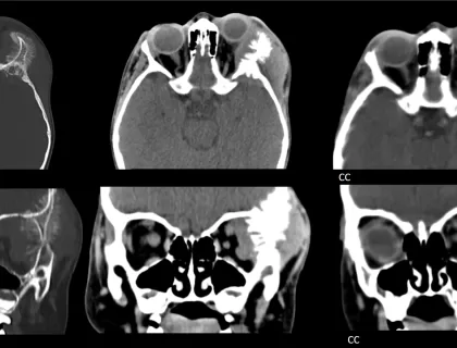 NEUROBLASTOMA