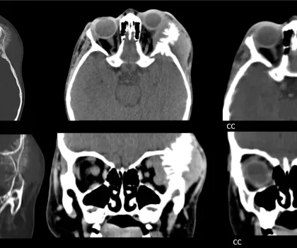 NEUROBLASTOMA