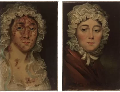 Sra. Bennet e seu impetigo